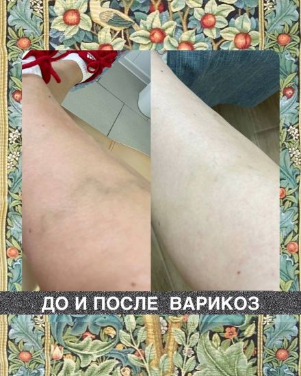 [Наталия Травникова] Варикоз (2025)_0.jpg